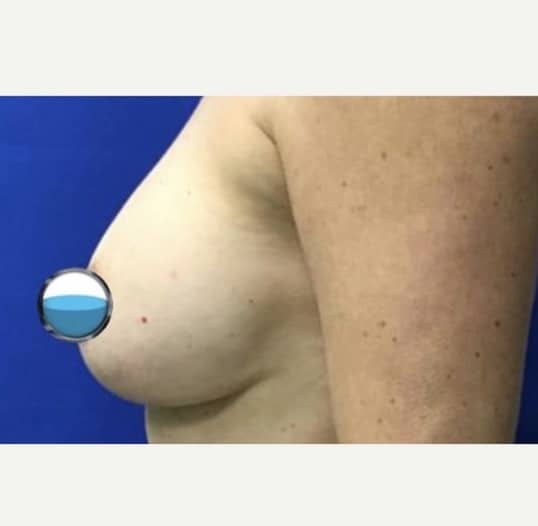 Before Image: Breast Explant Surgery with Lift - left-side