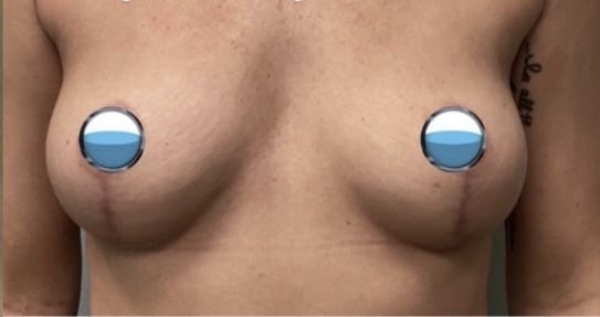 After Image: Breast Explant Surgery with Lift: 5 Months Post Op - front