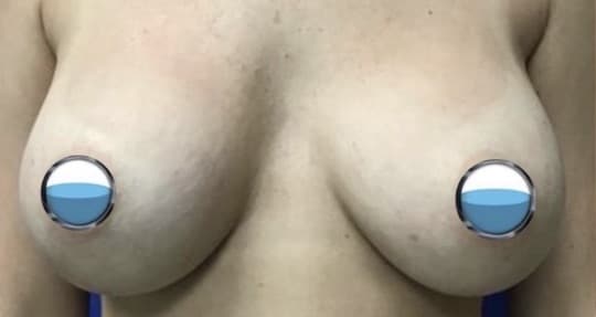 Before Image: Breast Explant Surgery with Lift: 5 Months Post Op - front