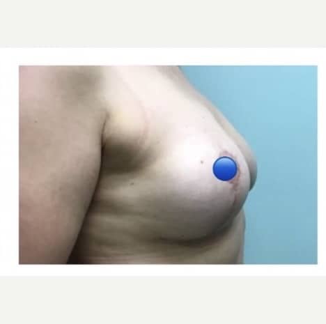 After Image: Breast Explant Surgery and Lift: 1 Month Post Op - right-side