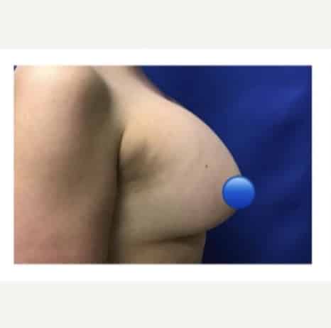 Before Image: Breast Explant Surgery and Lift: 1 Month Post Op - right-side