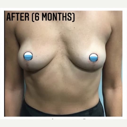 After Image: Breast Explant Surgery and Lift: 6 Months Post Op - front