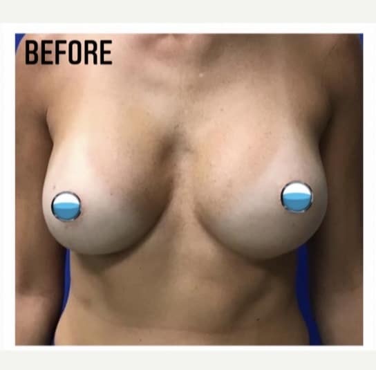 Before Image: Breast Explant Surgery and Lift: 6 Months Post Op - front