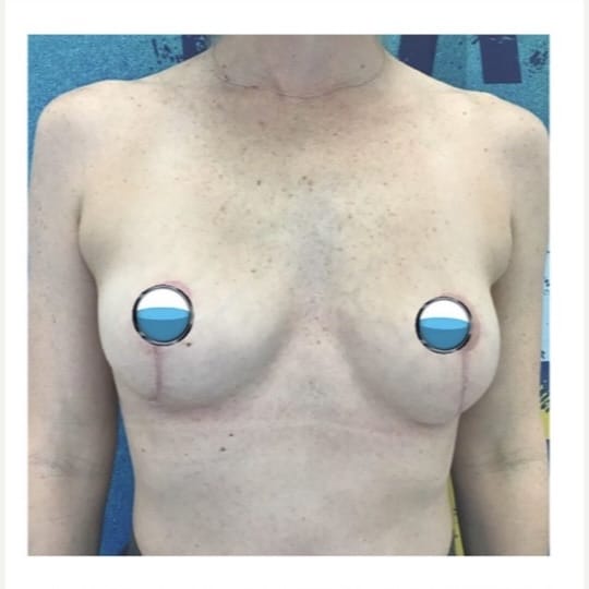 After Image: Breast Explant Surgery and Lift: 2 Months Post Op - front