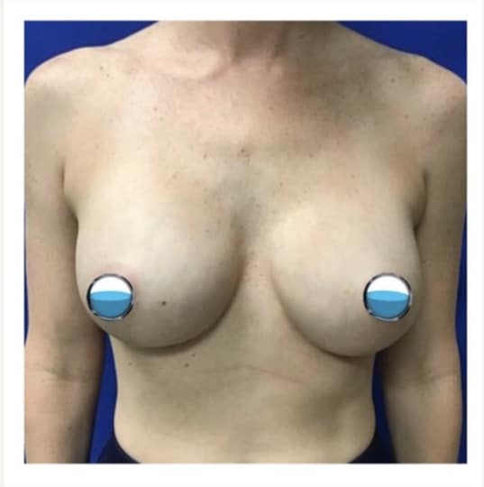 Before Image: Breast Explant Surgery and Lift: 2 Months Post Op - front
