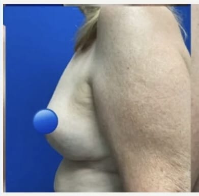 After Image: Breast Explant Surgery and Lift: 1 Month Post Op - left-side