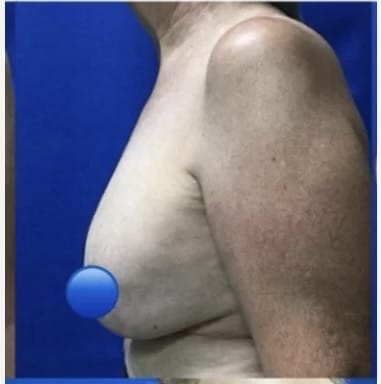 Before Image: Breast Explant Surgery and Lift: 1 Month Post Op - left-side