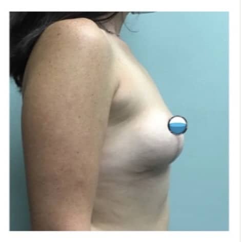After Image: Breast Explant Surgery and Lift - right-side