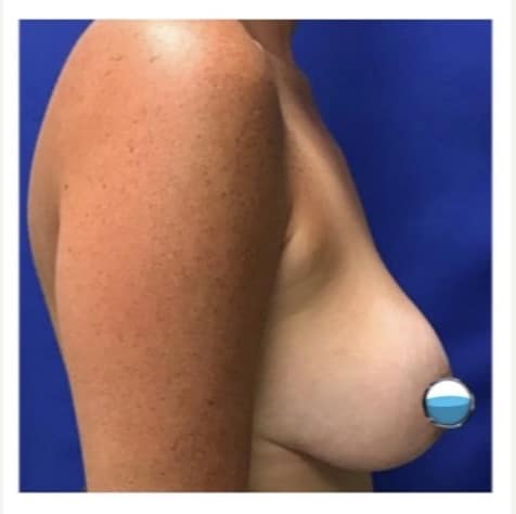 Before Image: Breast Explant Surgery and Lift - right-side