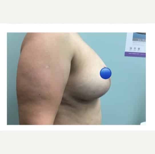 After Image: Breast Explant Surgery and Lift: 6 Months Post Op - right-side