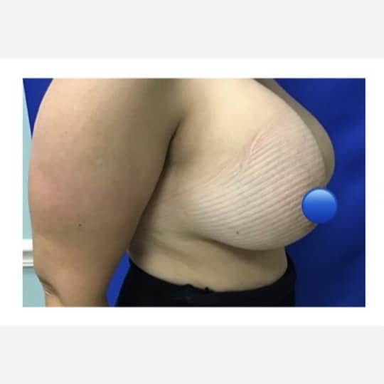 Before Image: Breast Explant Surgery and Lift: 6 Months Post Op - right-side