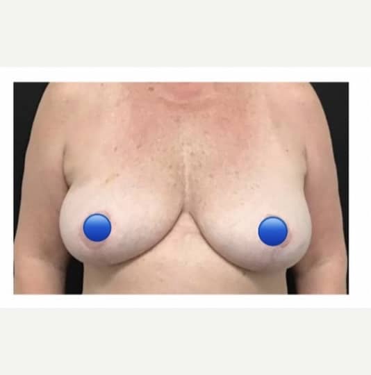 After Image: Breast Explant Surgery and Lift: 1 Year Post Op - front
