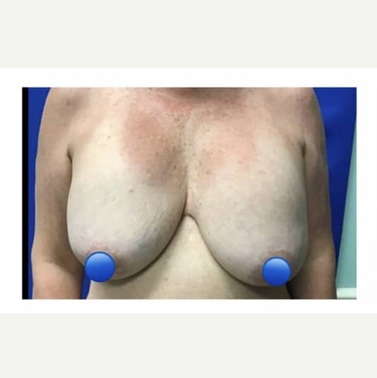 Before Image: Breast Explant Surgery and Lift: 1 Year Post Op - front