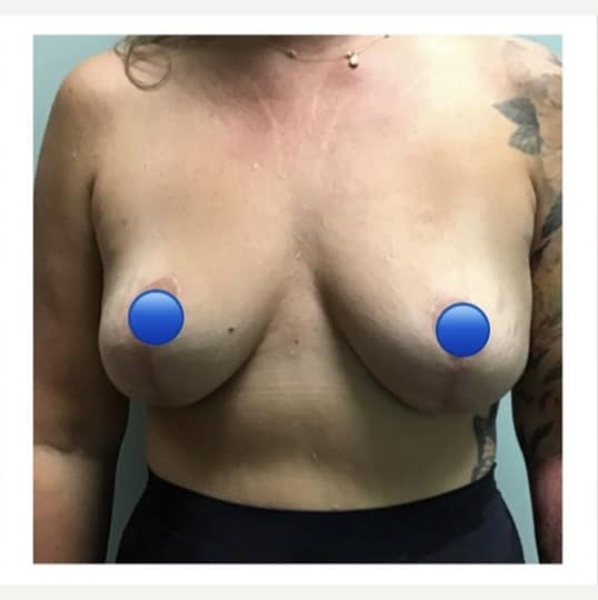 After Image: Breast Explant Surgery and Lift: 6 Months Post Op - front