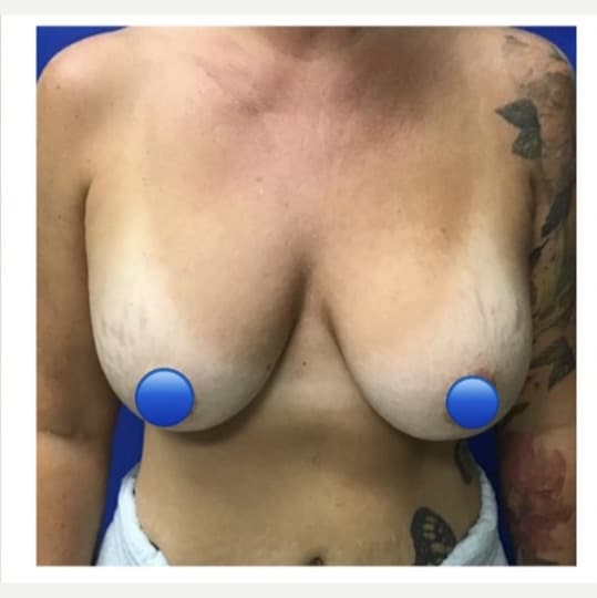 Before Image: Breast Explant Surgery and Lift: 6 Months Post Op - front