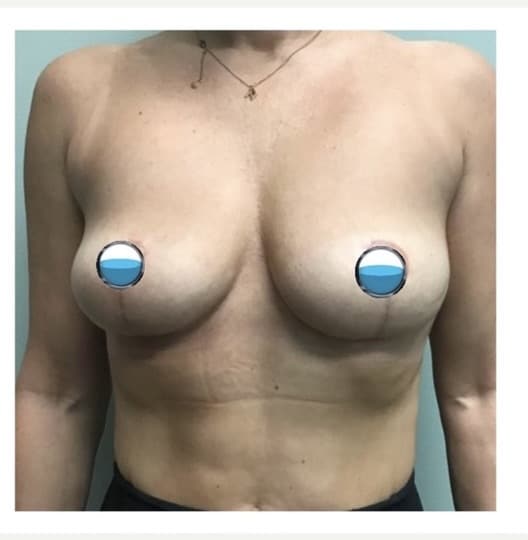 After Image: Breast Explant Surgery and Lift: 7 Weeks Post Op - front