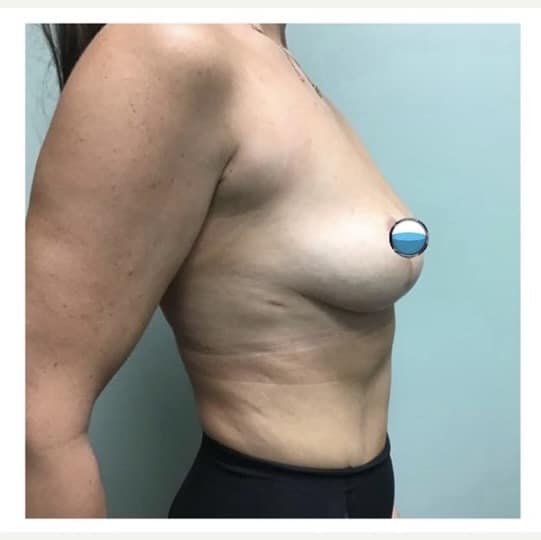 After Image: Breast Explant Surgery and Lift: 7 Weeks Post Op - right-side