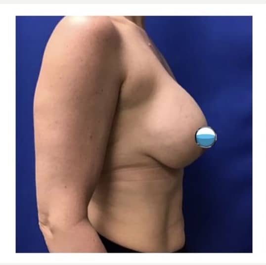 Before Image: Breast Explant Surgery and Lift: 7 Weeks Post Op - right-side