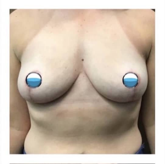 After Image: Breast Explant Surgery with Lift: 2 Months Post Op - front
