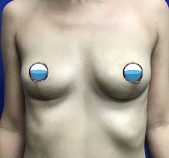 After Image: Breast Explant Surgery and Lift: 1 Year Post Op - front