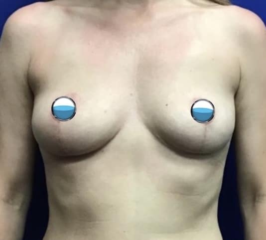 After Image: Breast Explant Surgery: 1 Year Post Op - front