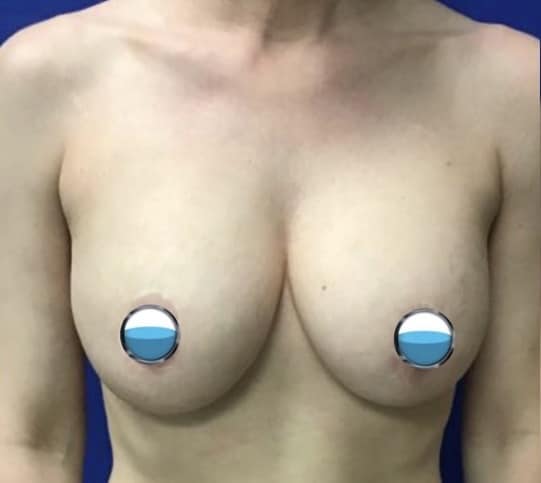Before Image: Breast Explant Surgery: 1 Year Post Op - front