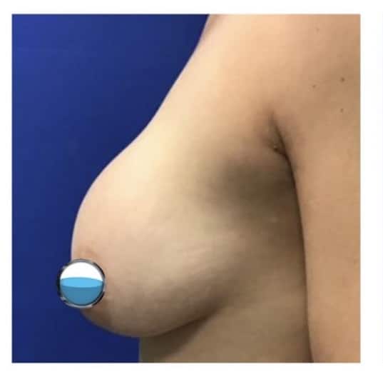Before Image: Breast Explant Surgery and Lift: 17 Months Post Op - left-side