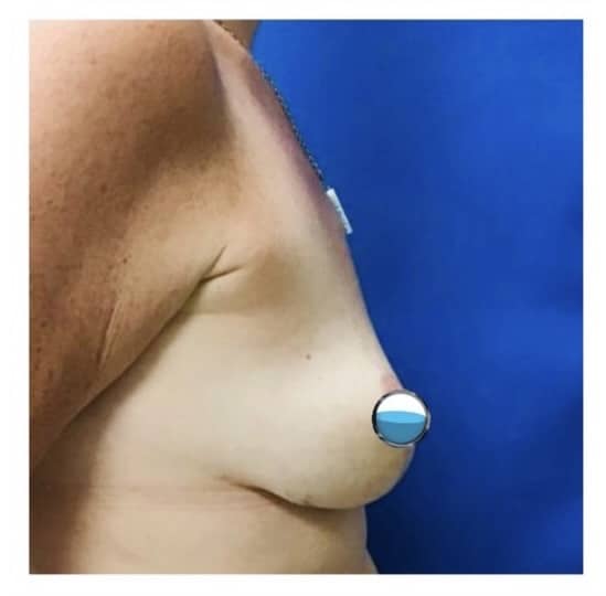 After Image: Breast Explant Surgery and Lift: 4 Months Post Op - right-side