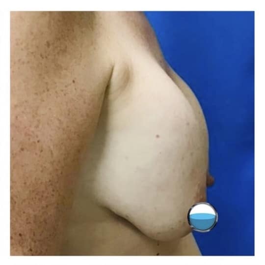 Before Image: Breast Explant Surgery and Lift: 4 Months Post Op - right-side