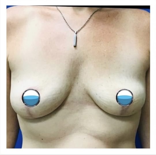 After Image: Breast Explant Surgery and Lift: 4 Months Post Op - front