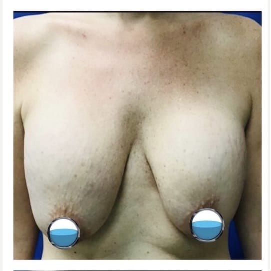 Before Image: Breast Explant Surgery and Lift: 4 Months Post Op - front