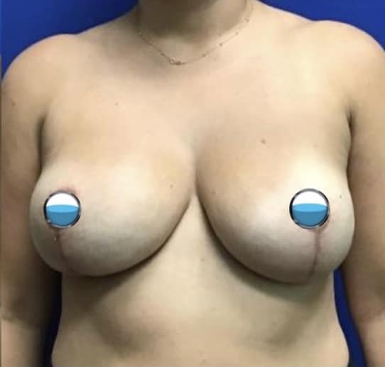 After Image: Breast Explant Surgery and Lift: 1 Month Post Op - front