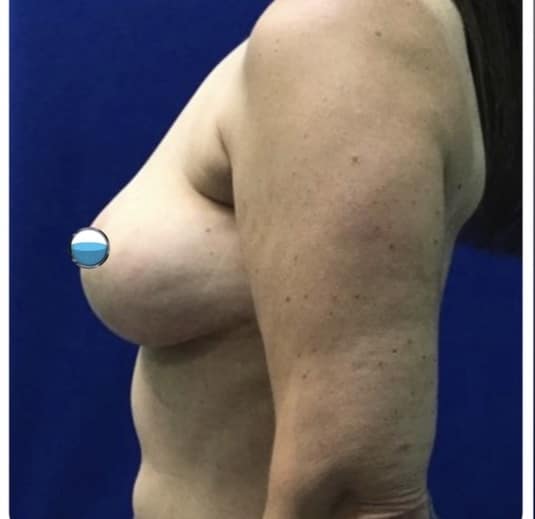 After Image: Breast Explant Surgery and Lift: 1 Year Post Op - left-side