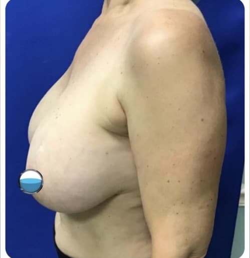 Before Image: Breast Explant Surgery and Lift: 1 Year Post Op - left-side