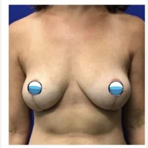 After Image: Breast Explant Surgery and Lift: 4 Months Post Op