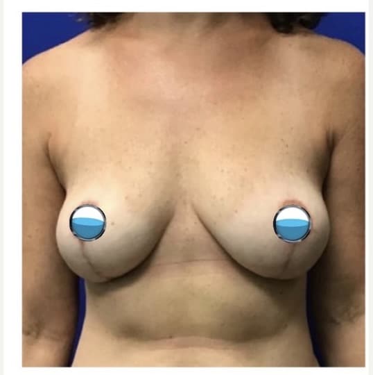 After Image: Breast Explant Surgery and Lift: 4 Months Post Op - front