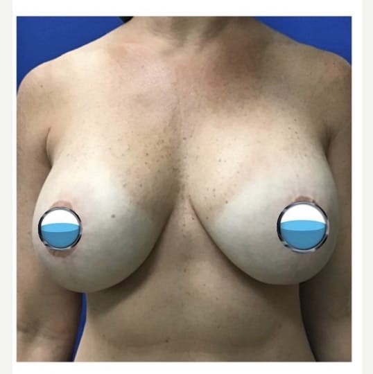 Before Image: Breast Explant Surgery and Lift: 4 Months Post Op - front