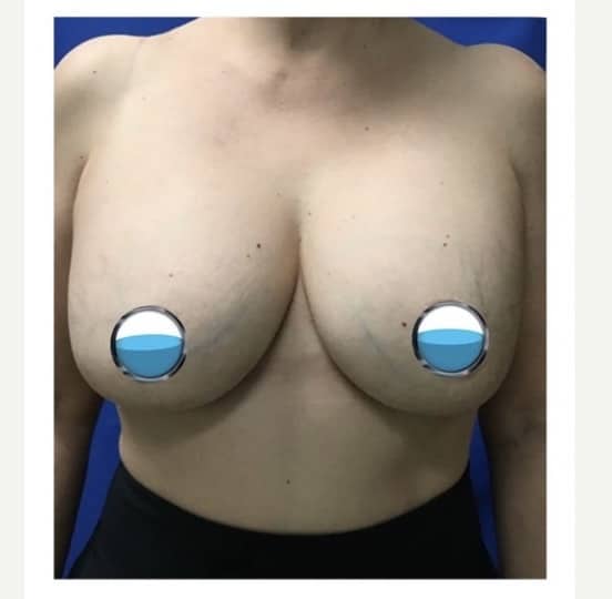 Before Image: Breast Explant Surgery and Lift: 5 Weeks Post Op - front
