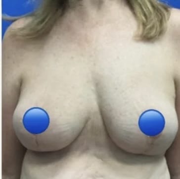 After Image: Breast Explant Surgery and Lift: 1 Month Post Op - front