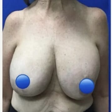 Before Image: Breast Explant Surgery and Lift: 1 Month Post Op - front
