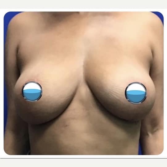 After Image: Breast Explant Surgery and Lift: 4 Months Post Op - front