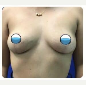 After Image: Breast Explant Surgery and Lift: 5 Months Post Op
