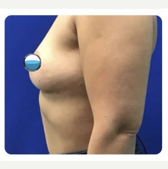 After Image: Breast Explant Surgery and Lift: 5 Months Post Op - left-side