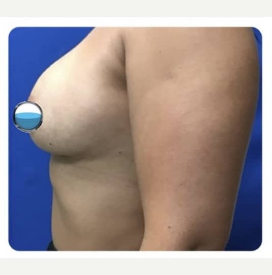 Before Image: Breast Explant Surgery and Lift: 5 Months Post Op - left-side