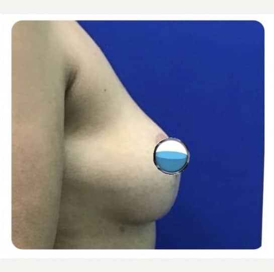 After Image: Breast Explant Surgery and Lift: 5 Months Post Op - right-side