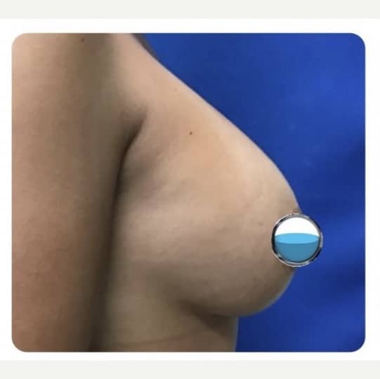 Before Image: Breast Explant Surgery and Lift: 5 Months Post Op - right-side