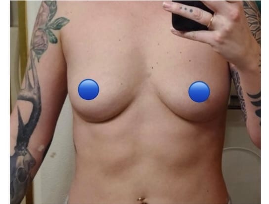 After Image: Breast Explant Surgery: Patient Testimonial - front