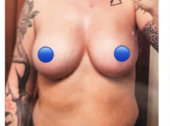 Before Image: Breast Explant Surgery: Patient Testimonial - front