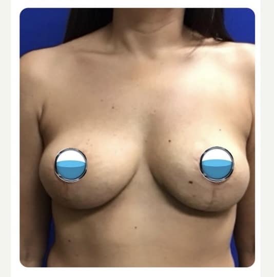 After Image: Breast Explant Surgery and Lift: 1 Month Post Op - front