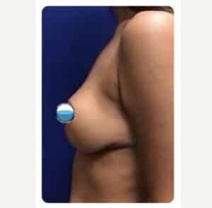After Image: Breast Explant Surgery and Lift: 1 Month Post Op